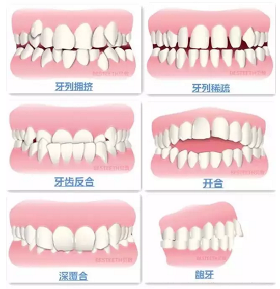 【口腔科普】關(guān)于矯牙前、中、后需要注意的問題，了解一下？