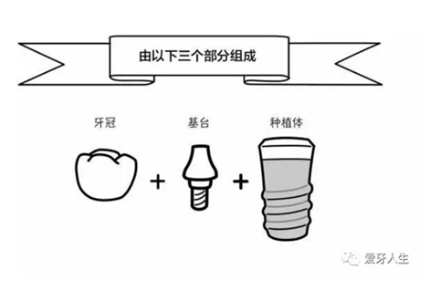 如何選擇種植牙，給《患者》推薦這篇文章就足矣