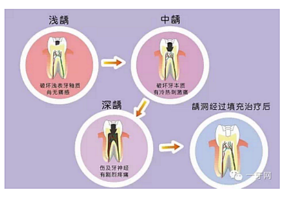 詳解牙疼的原因分幾種？