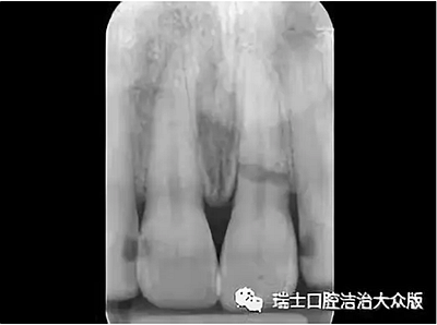 成人牙齒外傷了怎么應急處理？