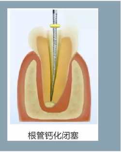 多頻技術(shù)的根管長(zhǎng)度測(cè)定儀