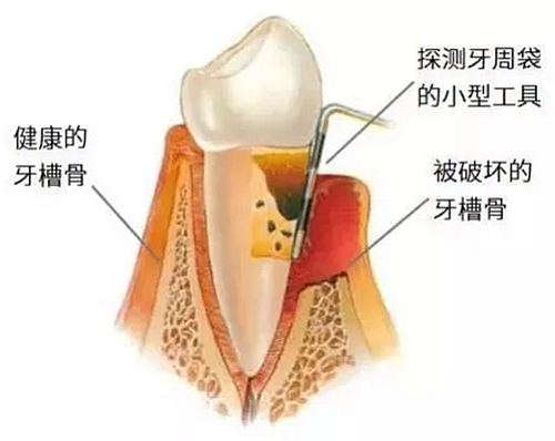 上海嘉?？谇谎芯克皇兰o(jì)牙周病的臨床進(jìn)展