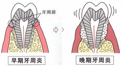 上海嘉?？谇谎芯克皇兰o(jì)牙周病的臨床進(jìn)展