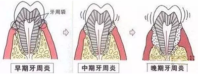 上海嘉?？谇谎芯克皇兰o(jì)牙周病的臨床進(jìn)展