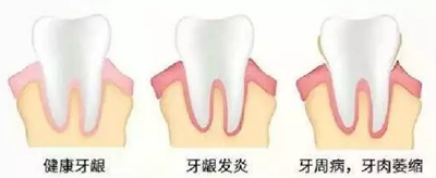 牙周炎，中國成年人后半生永遠的 痛 ！