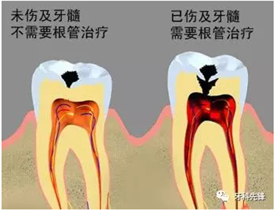 補(bǔ)牙不做冠，療效少一半！根管治療后牙齒已經(jīng)不疼了，為什么還要戴牙冠呢？