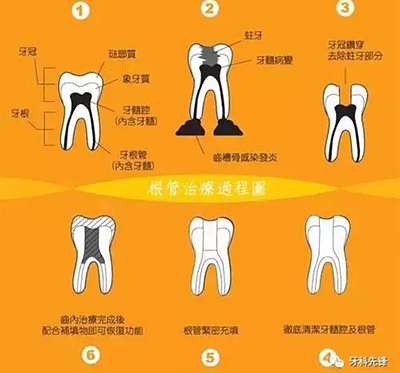 補(bǔ)牙不做冠，療效少一半！根管治療后牙齒已經(jīng)不疼了，為什么還要戴牙冠呢？